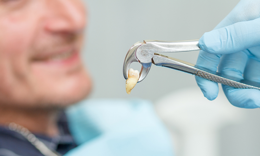 Tooth Extraction